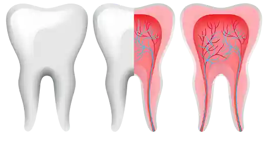Root Canal Steps in Vizag